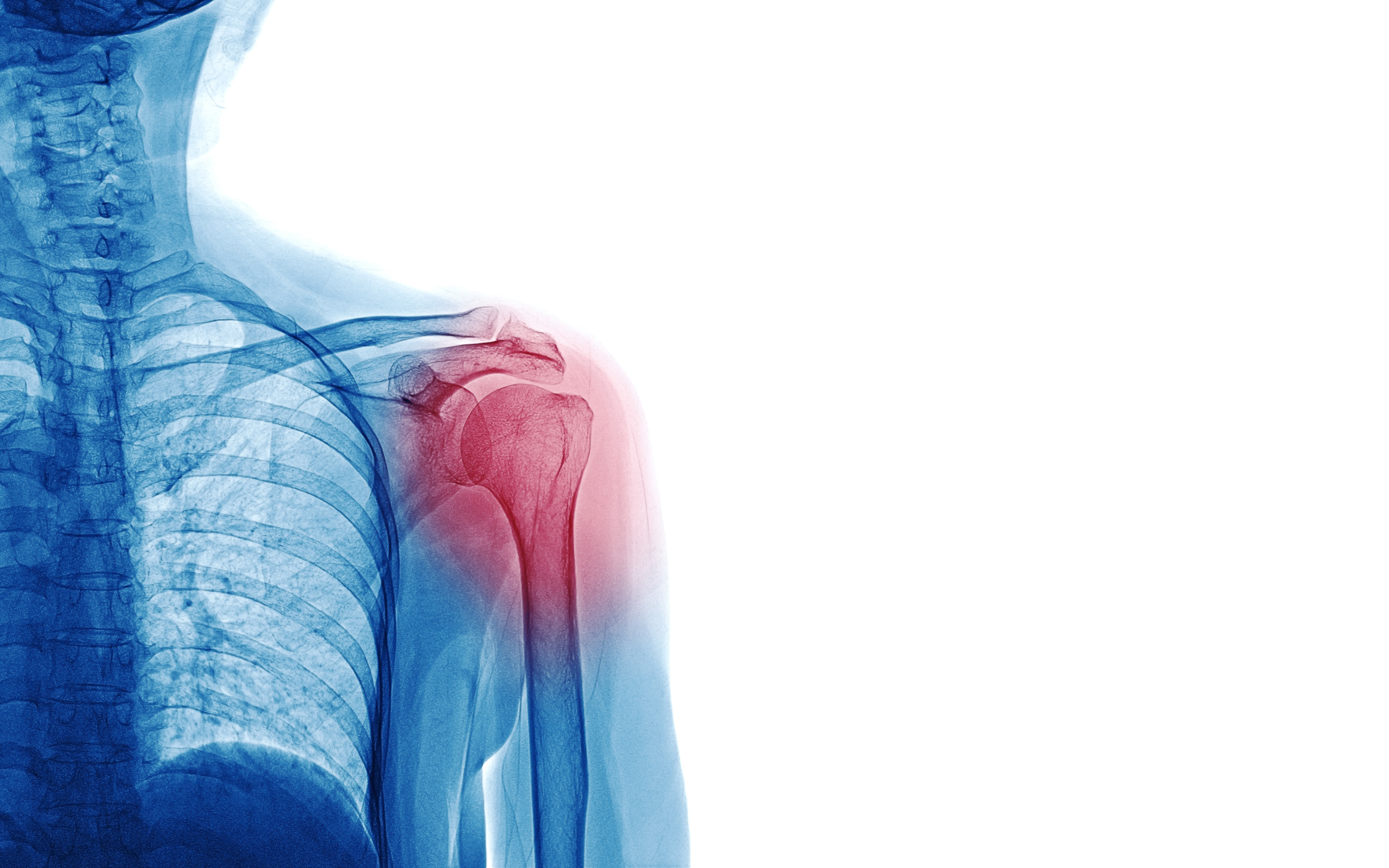 Clinical Overview: Approach into the Classification and Management of Patients with Shoulder Pain